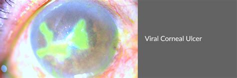 Corneal Ulcer Amritsar Eye Clinic