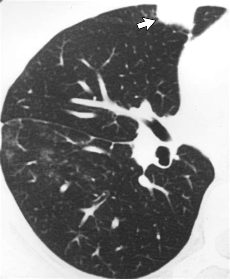Mycoplasma Pneumoniae Pneumonia Radiographic And High Resolution Ct