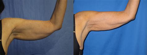 Liposuction Arms Axillary Before And After Pictures Case 6 Coeur
