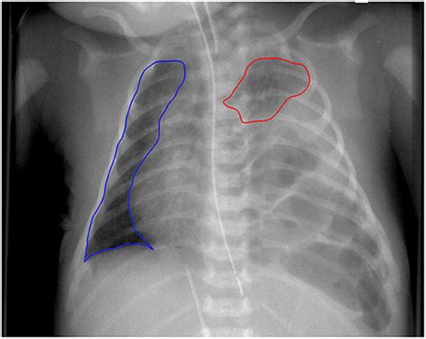 Frontiers The Chest Radiographic Thoracic Area Can Serve As A