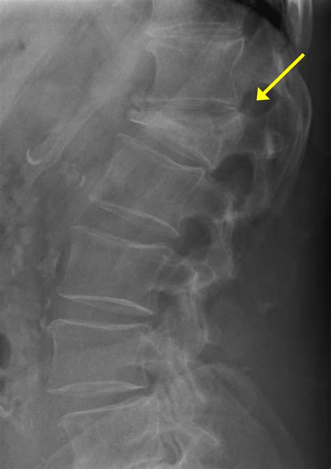 Lumbar Spine Trauma Radiology U Of U School Of Medicine
