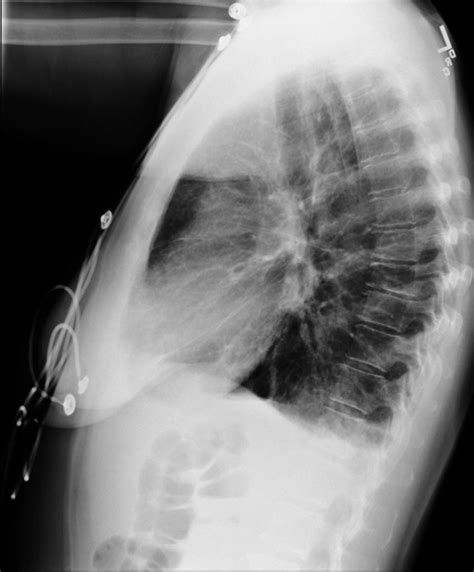 Normal Chest X Ray Pa And Lateral