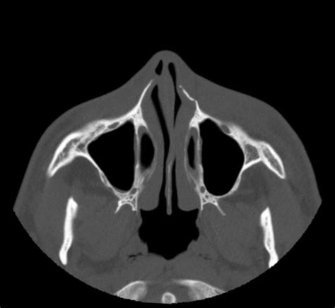 In their first year, residents should be well versed with normal radiographs, ultrasound and ct anatomy followed by mri in the consequent years. Nasal bone fracture | Radiology Case | Radiopaedia.org