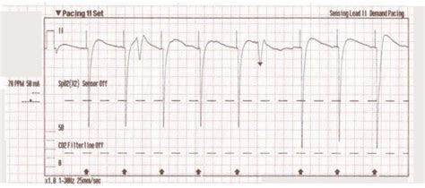 Transcutaneous Pacing Tcp With And Without Capture Acls Medical