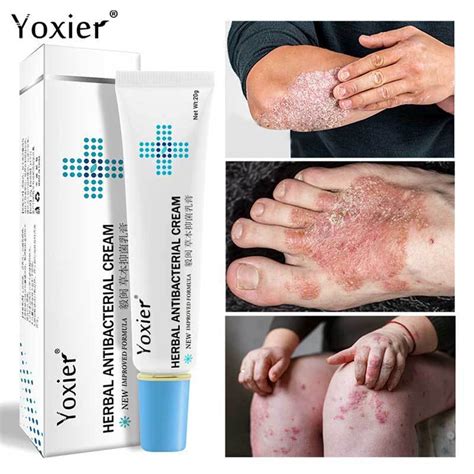 Herbal Antibacterial Antipruritic Eczema Sores Pityriasis Urticaria