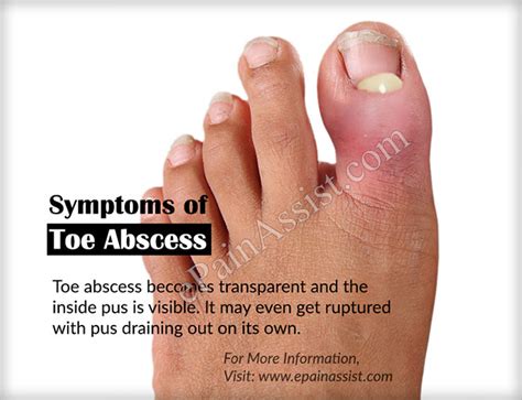 What Is Toe Abscesscausessymptomstreatmenthome Remediesprognosis