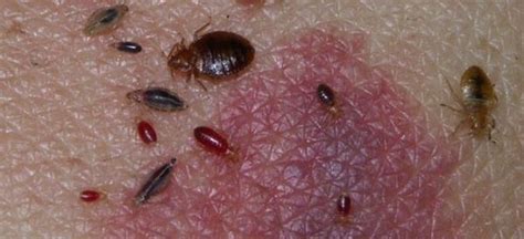 What Does Lice Look Like And What Are The Different Types