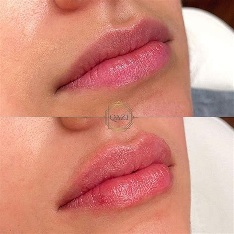 Lip Fillers In Orange County Ca Qazi Cosmetic Center