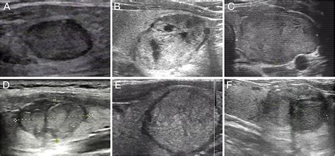 Thyroid Follicular Carcinoma Ultrasound