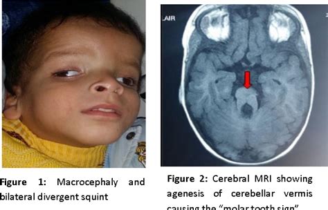 Figure 2 From The Management Of Joubert Syndrome In Physical Medicine