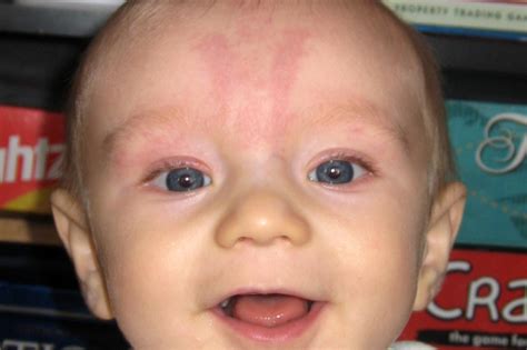 Rash On Baby Forehead