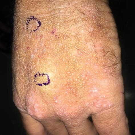 Smooth Papules On The Left Hand Mdedge Dermatology