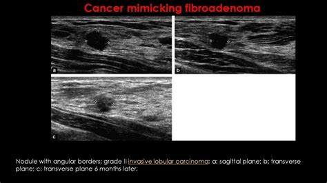 Breast Fibroadenoma Imaging