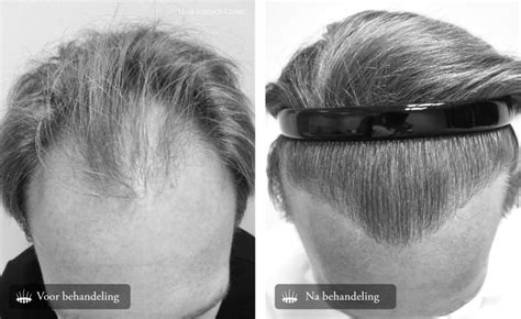 Hair Science Clinics Hair Transplant Before And After Pictures