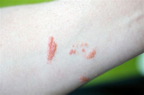 Poison Ivy Poison Oak And Rashes What You Need To Know
