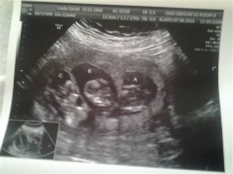 Ultrasound Pic Of T A S Triplets At 12weeks 3days Being Carried By