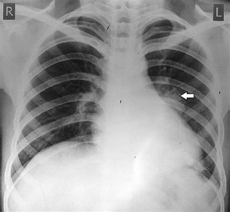 Chest X‑ray Pa Showing A Mass In The Left Hilar Region Indicated By