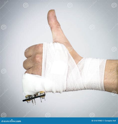 Injured Hand With Surgical Pins Stock Images Image 11827524 C15