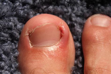 What Is An Ingrown Toenail