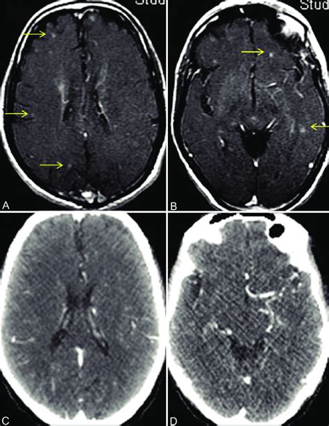 A D Brain Metastases In Asymptomatic Patient Ct Scan Versus Mri