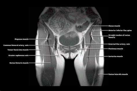 Pelvis Muscles Mri Anatomy Mri Anatomy Of Hip Joint Free Mri Axial