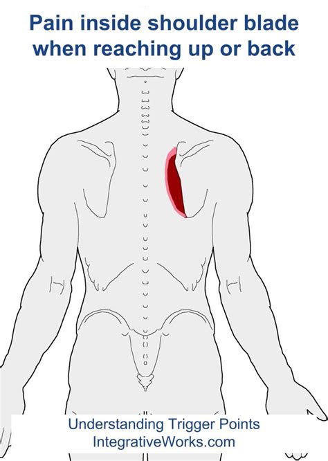 Trigger Points Pain When Reaching Up Or Back Integrative Works