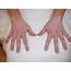 Rheumatologe Vitiligo In A Patient With Rheumatoid Arthritis Under 