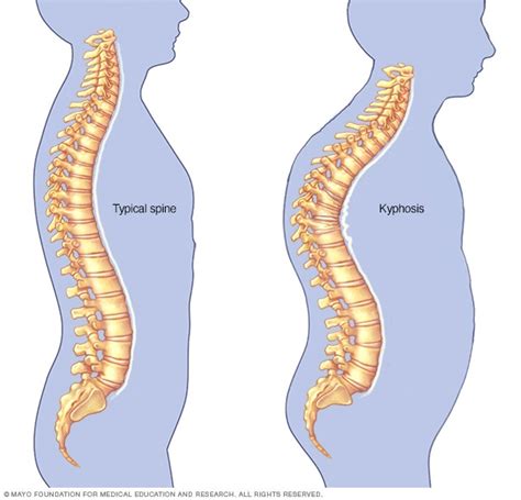 Cifosis Síntomas y causas Mayo Clinic