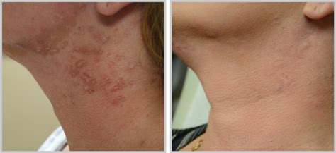 Is A Halo Laser Skin Treatment Worth It