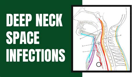 Deep Neck Space Infections Youtube