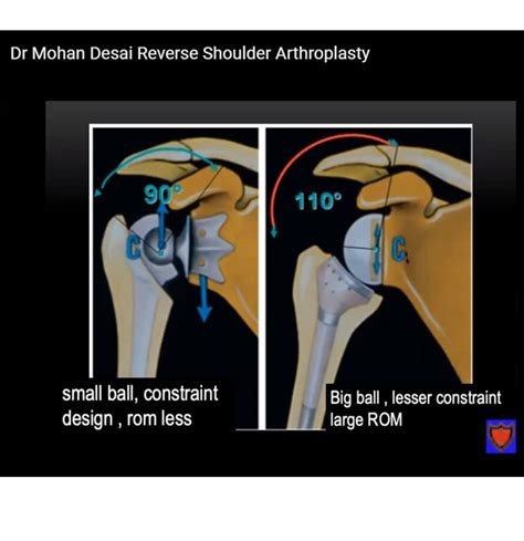 Reverse Shoulder Arthroplasty —