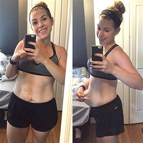 Woman Shares Photo Of Her Excess Skin To Show The Side Effects Of