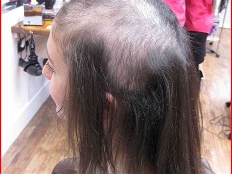 How To Get Rid Of Bald Spots For A Teenager Kids Hairstyles