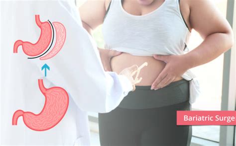 Top Bariatric Surgery Center In Ahmedabad Nobesity