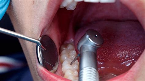 ¿qué Es La Alveolitis Dental Clínica Dental Dra Mª José Barra Soto
