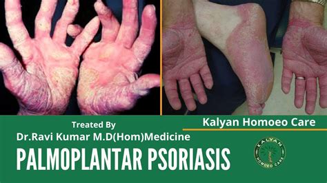 Best Palmoplantar Psoriasis Treatment And Medicine In Homeopathy Dr