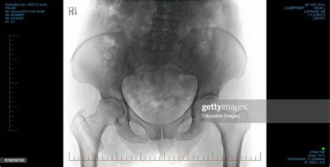 Positive Computer X Ray Of A Hip Showing Joints Needing Replacement