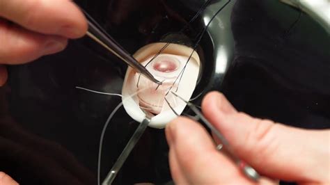 Simulated Surgery Retinal Buckling Placing The Sutures For A Scleral