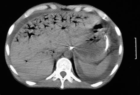Severe Abdominal Pain In An 85 Year Old Woman The Bmj