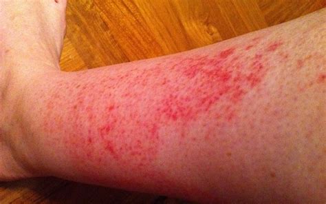 Itching Legs With No Rash