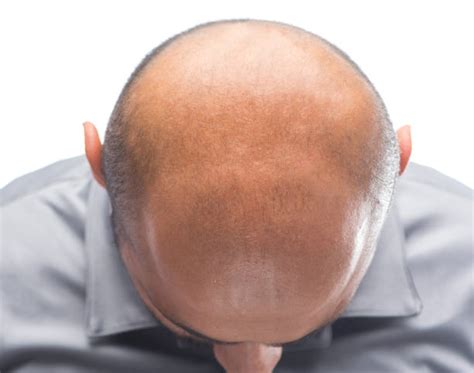 Completely Bald Shaved Head Human Head Rear View Stock Photos Pictures
