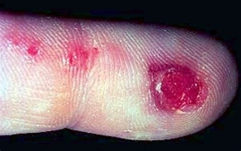 Herpetic Whitlow Pictures Treatment Contagious Symptoms