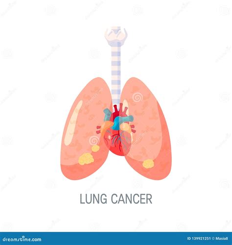 Lung Cancer Vector Concept In Flat Style Stock Vector Illustration Of