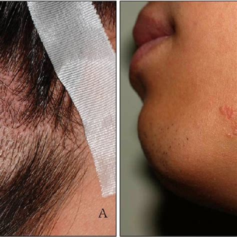 Nevus Sebaceous On The Scalp A And Chin B Download Scientific