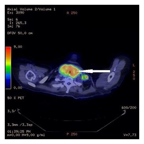 Pet Ct Scan Showing A Hypermetabolic Enlarged Thyroid Gland B