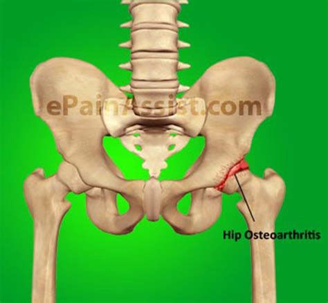 Hip Pain Caused By Hip Joint Osteoarthritiscausessymptomsdiagnosis