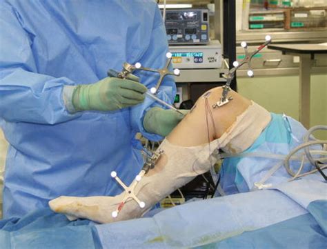 Acl Tear Surgery Procedure Acl Reconstruction Treatment Procedure Docopd The Most Common