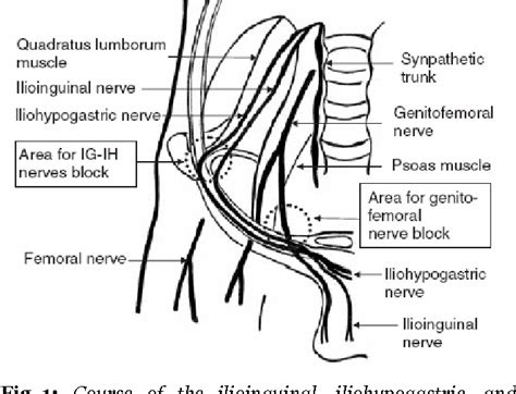 Ultrasound Guided Ilioinguinal Nerve Block Nevada Pai