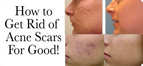 How To Get Rid Of Acne Scars For Good