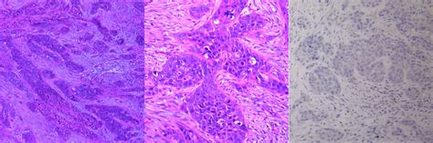 Invasive P16 Negative Squamous Cell Cancer Scc Of The Nasal Septum